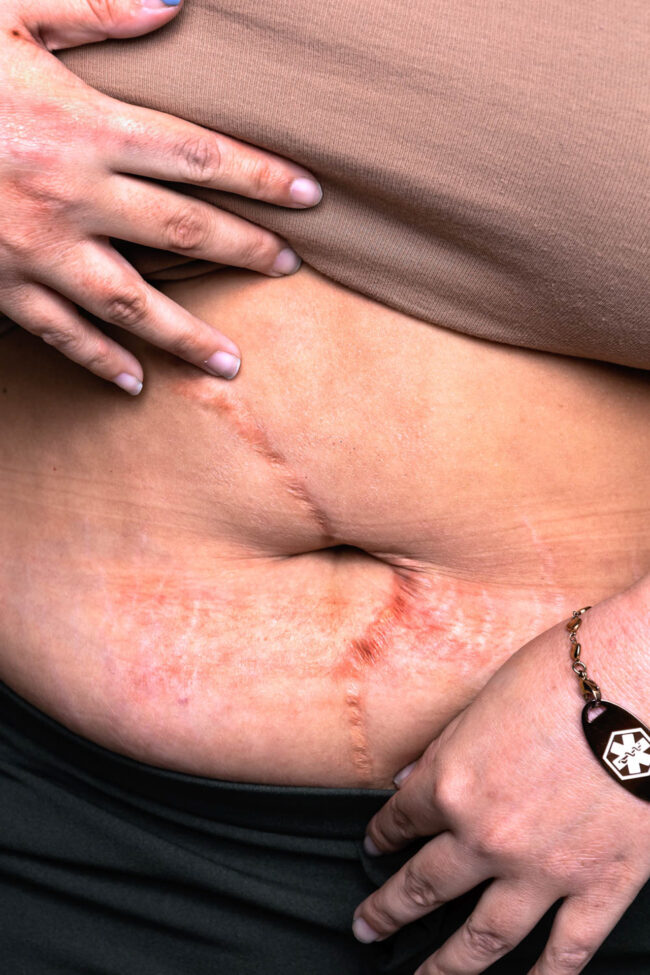 This photograph depicts a close up of someone's stomach scar, their hands rest on the top and bottom of their stomach that is partially exposed.